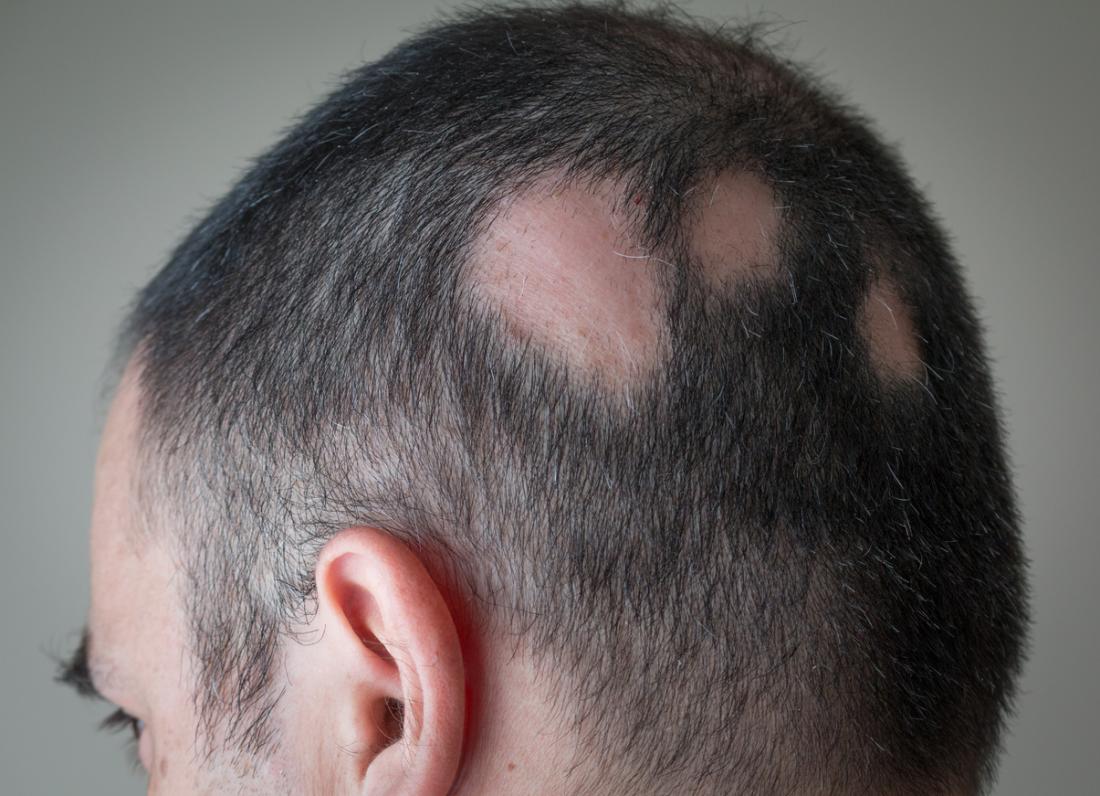 Treatment Options for Alopecia Areata