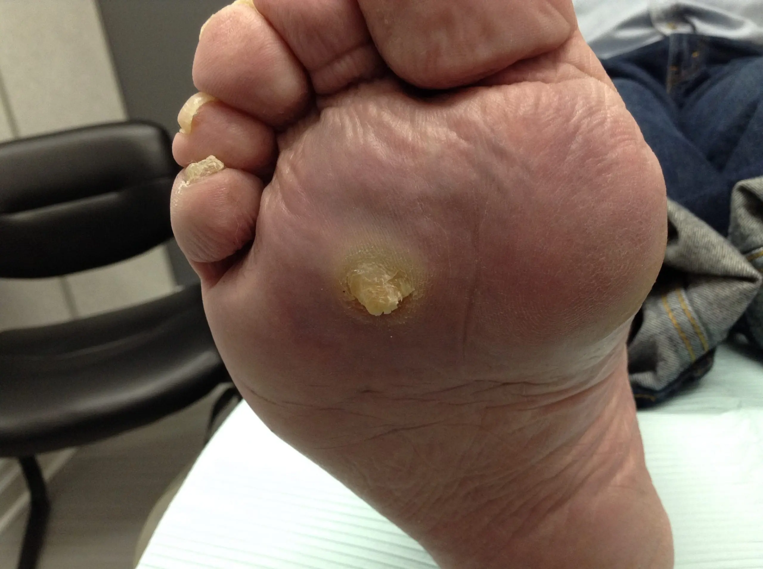 Why Do You Keep Getting Calluses on Your Feet?