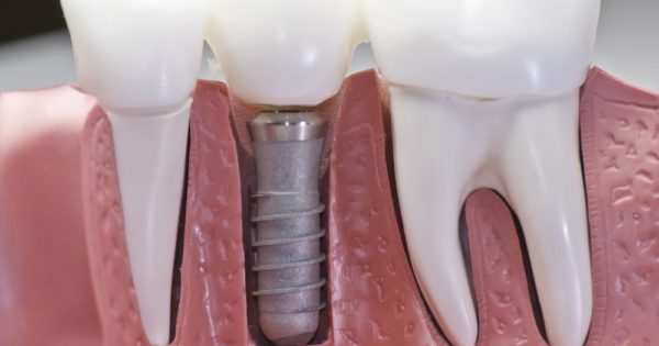 Top Benefits Of Dental Implants A Health GUI