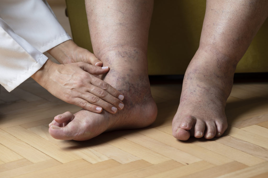 Is Peripheral Neuropathy Common?