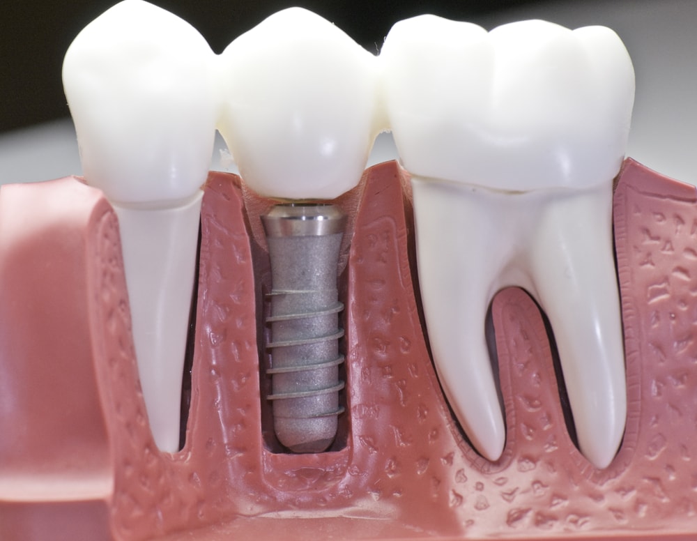 What To Note Before Having Dental Implants