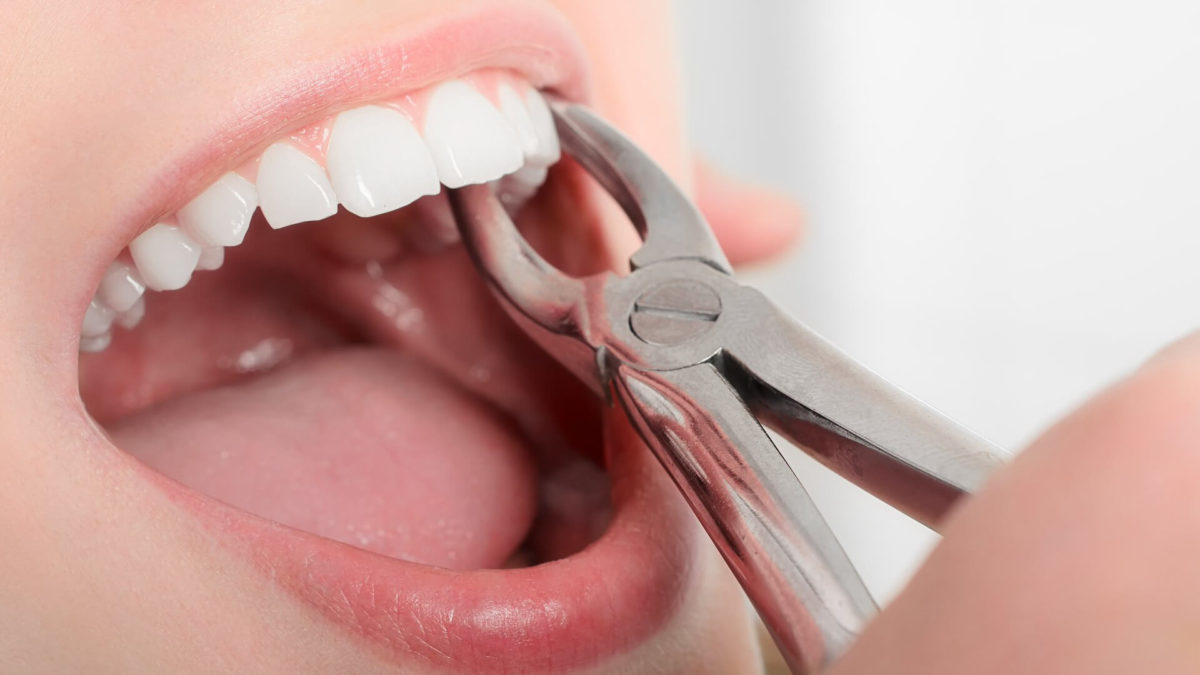 5 Essential Steps to Take in Preparation for a Tooth Extraction
