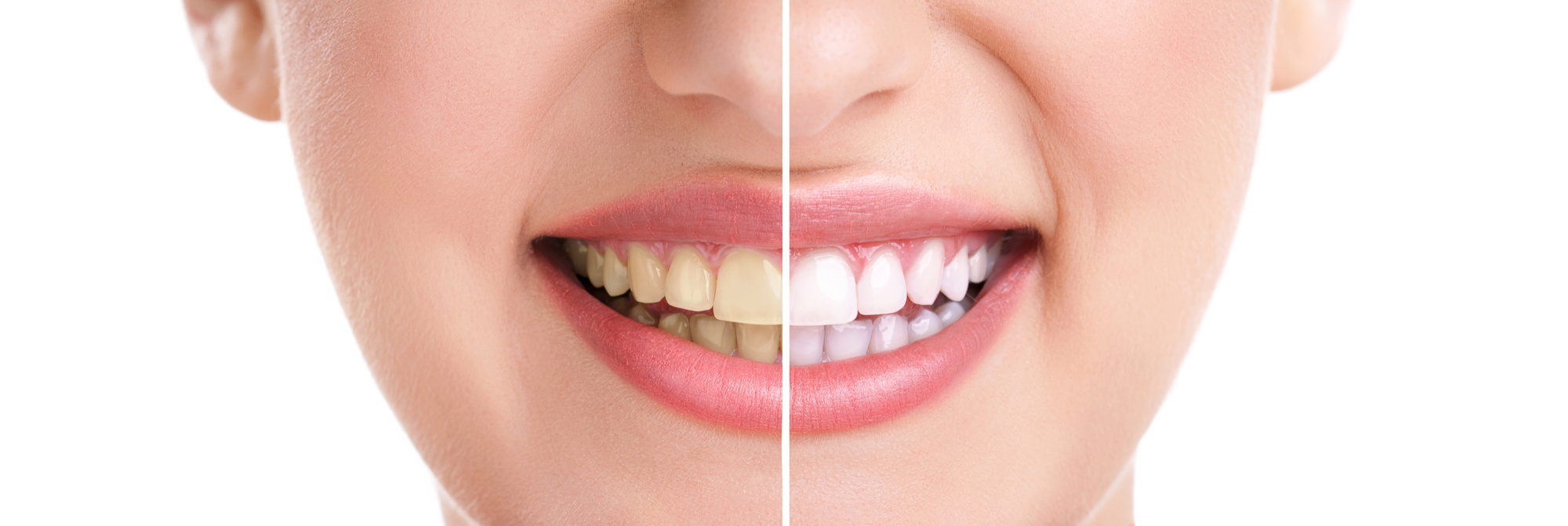 The Outstanding Benefits of Teeth Whitening