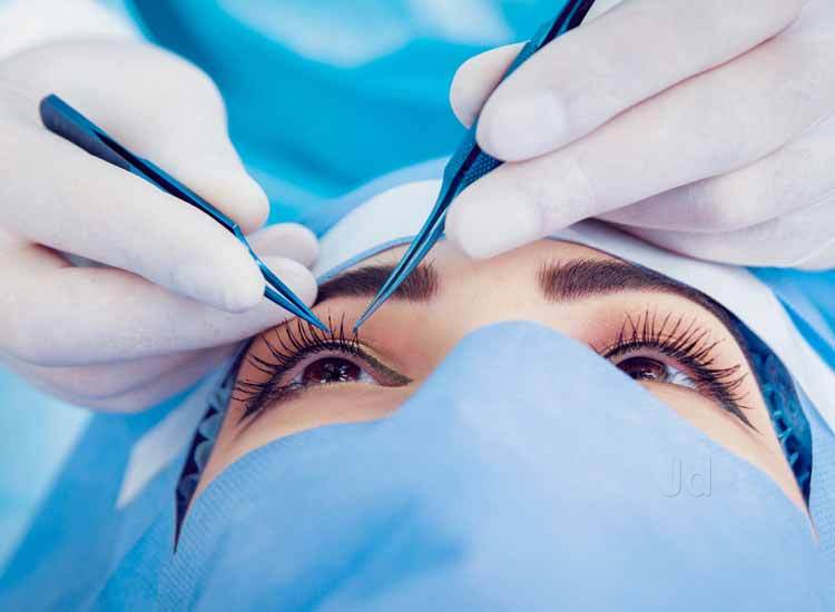 Essential Tips to Prepare for the LASIK Eye Surgery