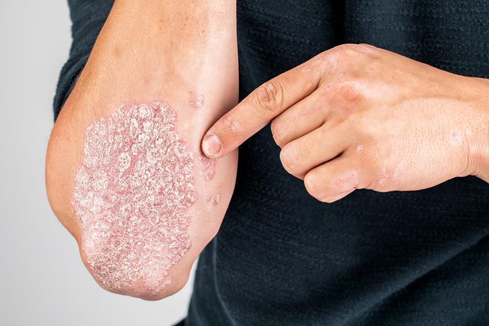 Causes and Triggers of Psoriasis: