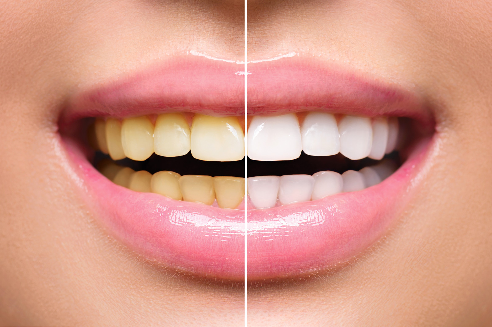 THE PROS AND CONS OF PROFESSIONAL TEETH WHITENING