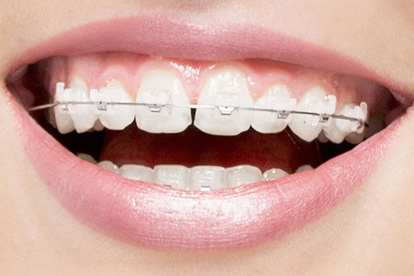 Why Clear Aligners Are Your Best Option To Straighten Your Smile