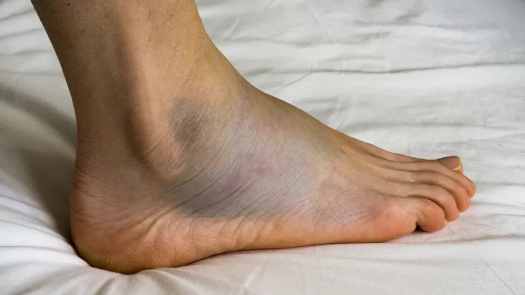 Beyond the Annoyance: The Hidden Dangers of Leg Swelling