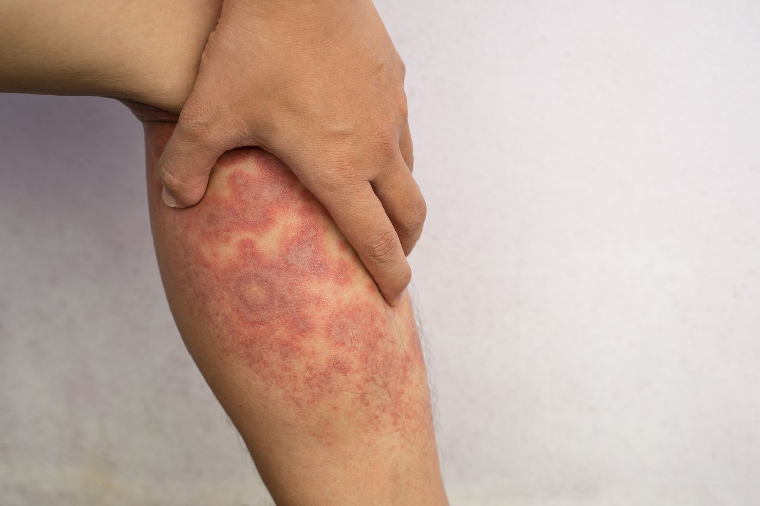 What are the most common symptoms of eczema?