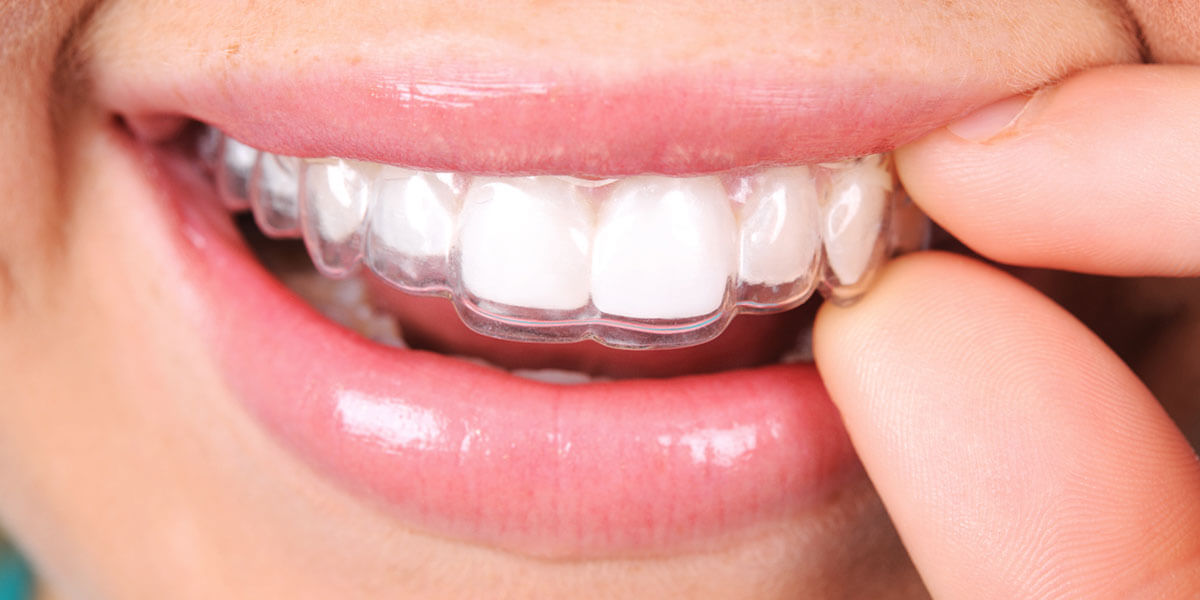 10 Implications of Adult Braces That Prove They Are Not Just for Aesthetics! 