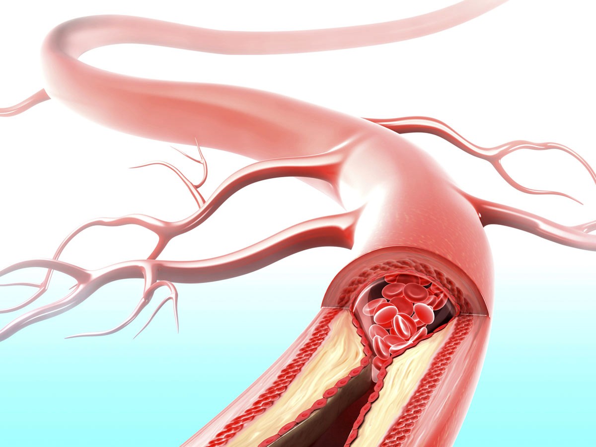 Managing Stress to Prevent Atherosclerosis