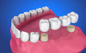 Porcelain Fixed Bridges: Your Super Affordable Solutions To Teeth Replacement 