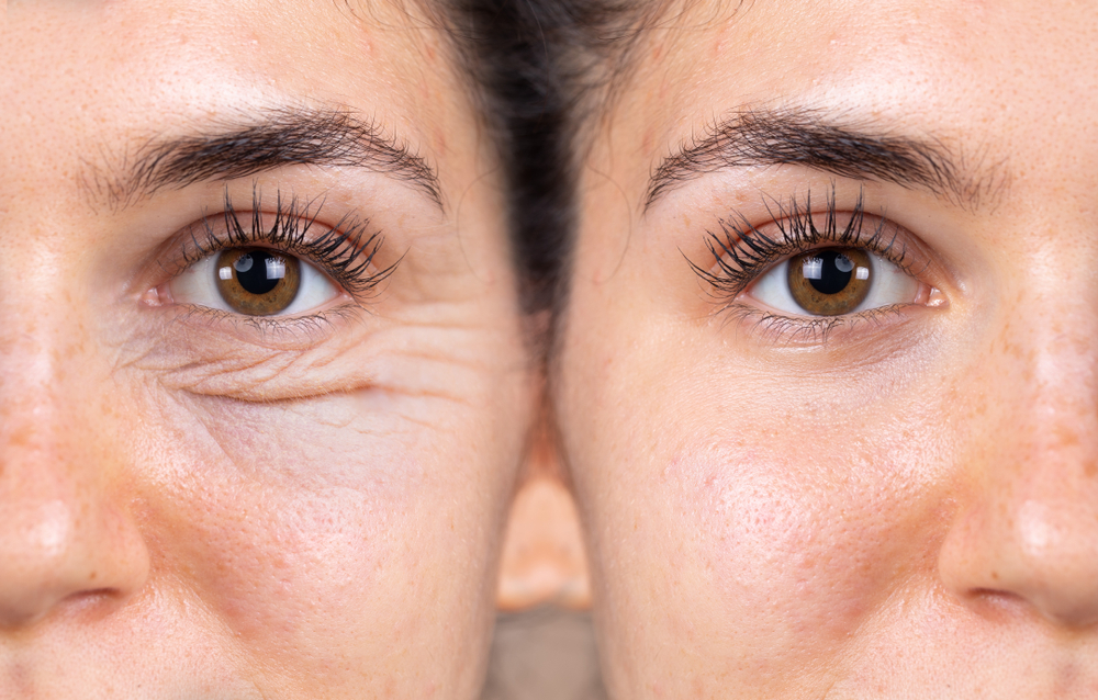 Understanding Picosure Laser: The Next Level in Skin Care 