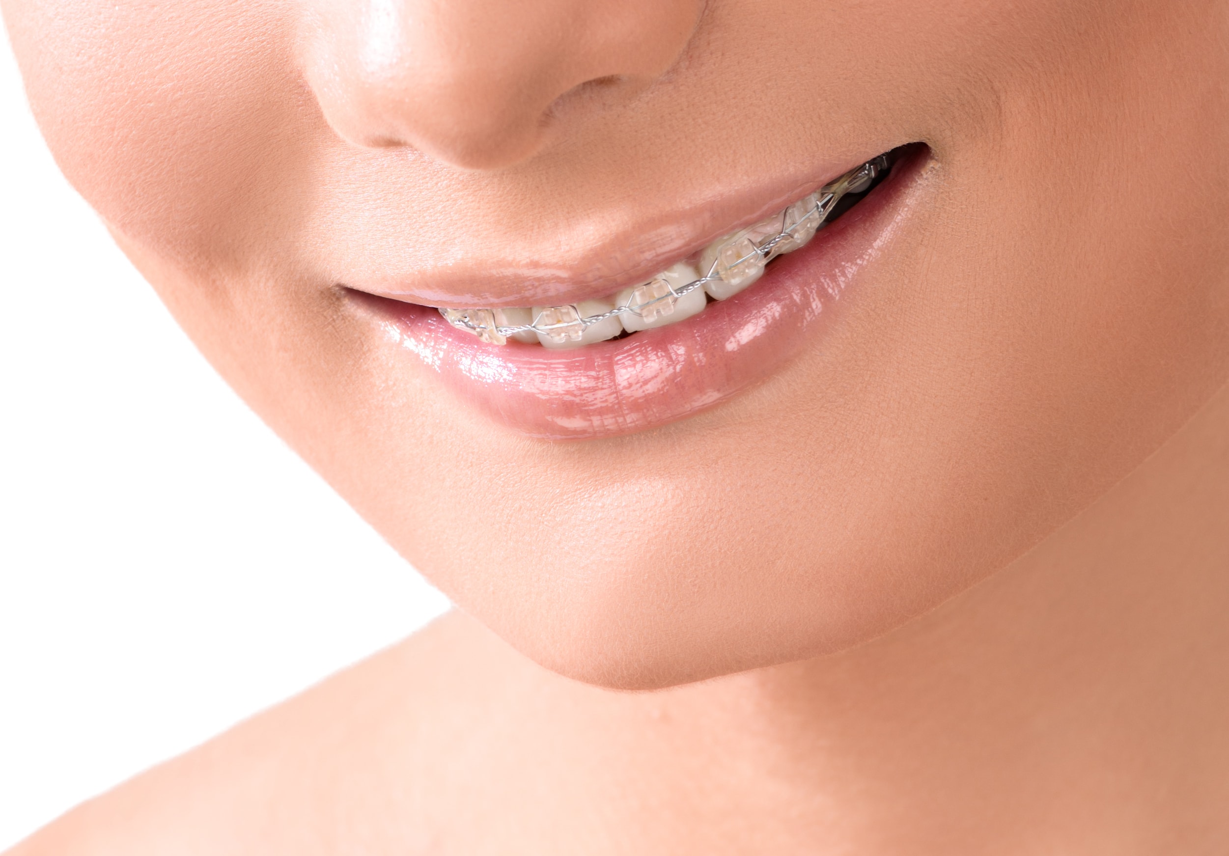 Clear Aligners: The Invisible Smile Corrector