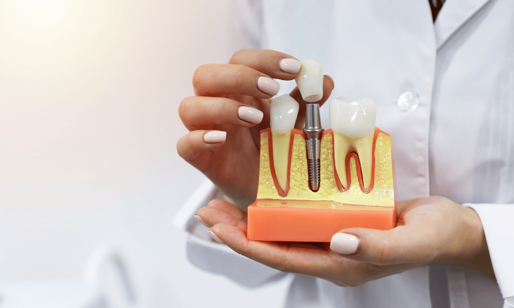 Full Arch Replacement through Dental Implants: A Comprehensive Guide