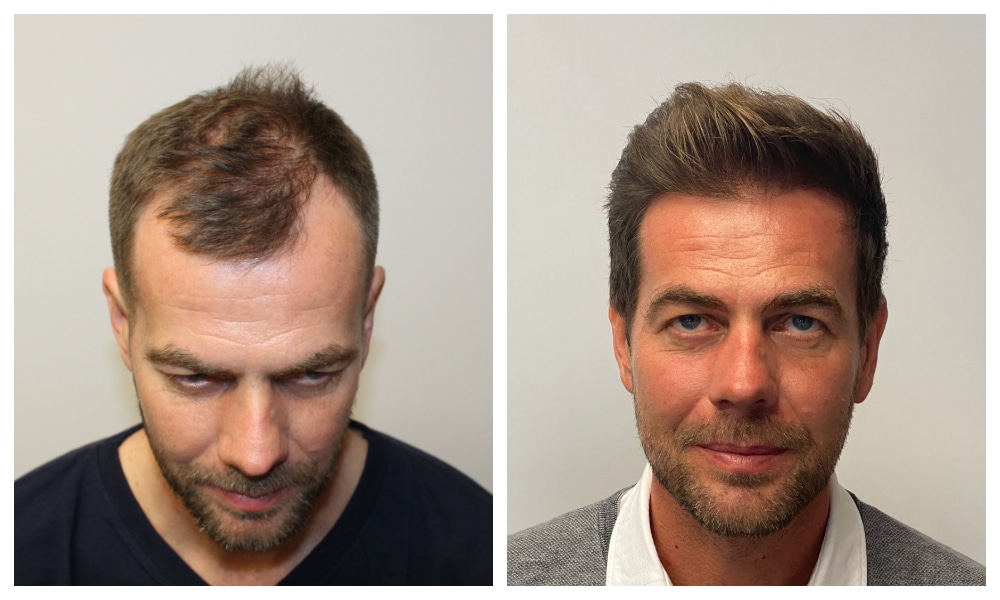 The Benefits Of Consulting With A Hair Restoration Specialist