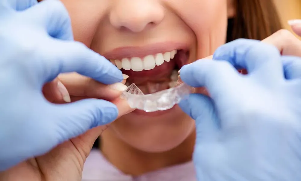 How to Maintain Oral Health While Wearing Clear Aligners?